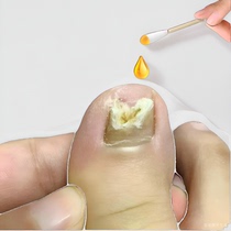 (Watson’s hot sale) One drop at a time no repairs antibacterial no removal buy 2 and get 1 free buy 3 and get 2 free