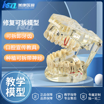 Dental Restoration Model Oral Pathology Doctor-Patient Communication Teaching Restoration Comprehensive Detachable Dental Model with Nerve