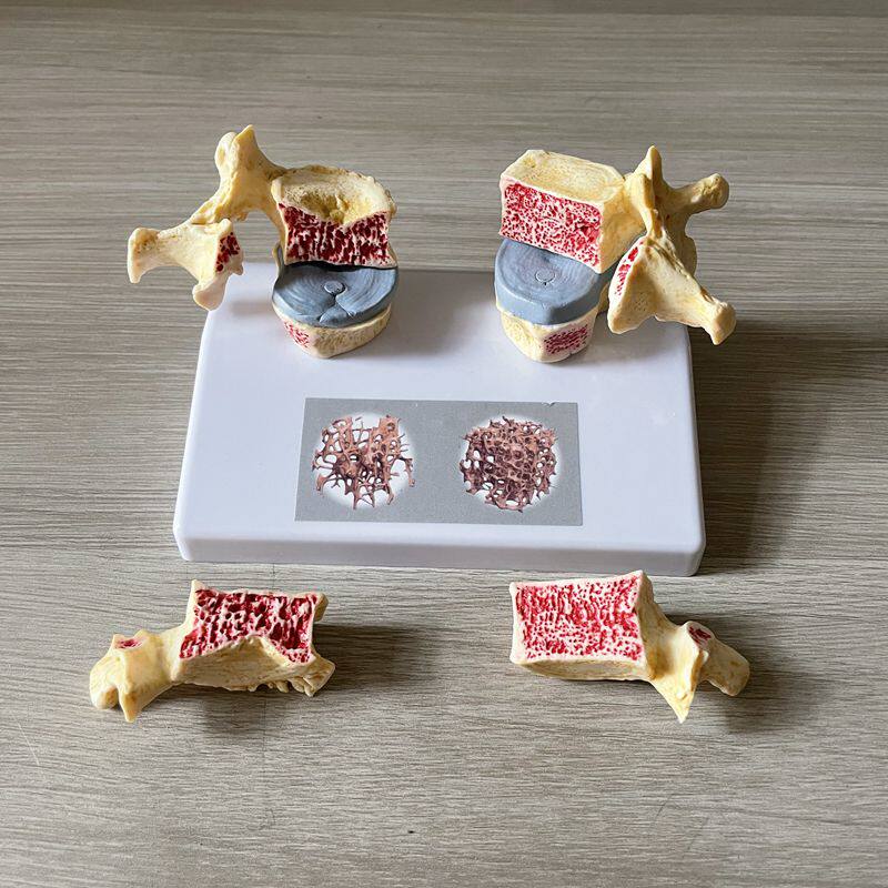 脊椎骨质模型疏松变化密度松质骨密质骨长骨结构病理医患医药礼品