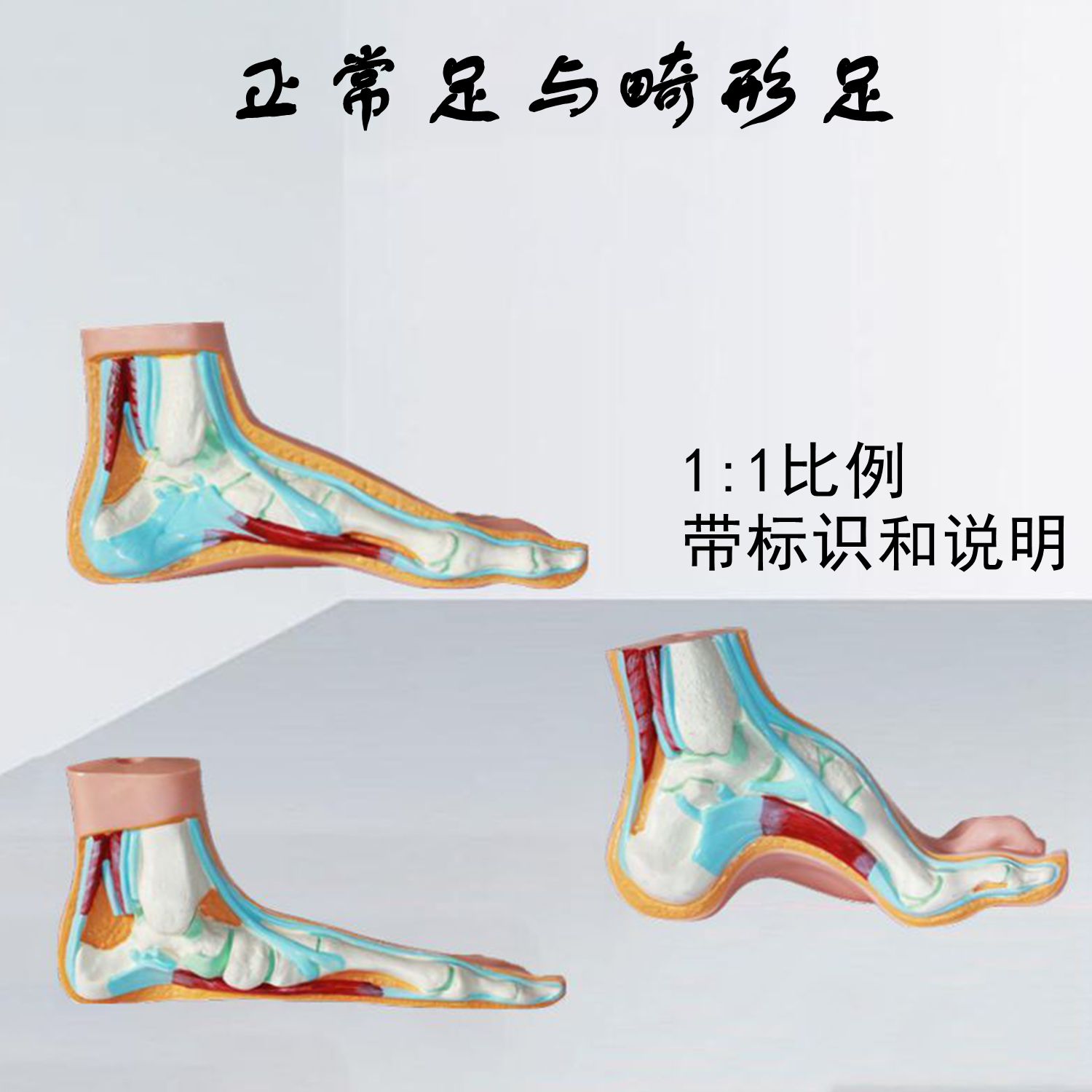 畸形脚模型弓形高弓平底足鸭掌扁平足鞋店摆件人体脚解剖皮肤骨骼