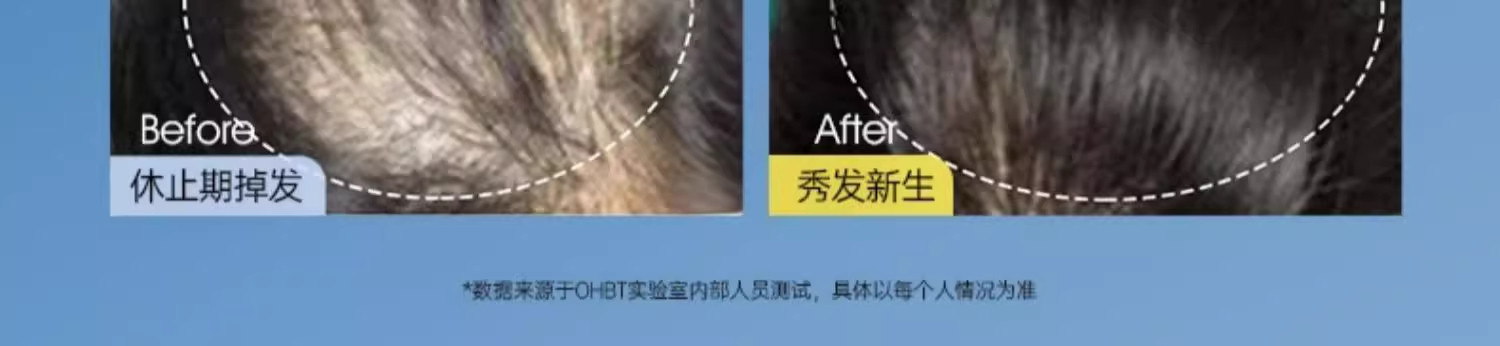 【香港直邮】 OHBT 防脱育发精华 100ml 男女通用 油头救星 打造健康头皮