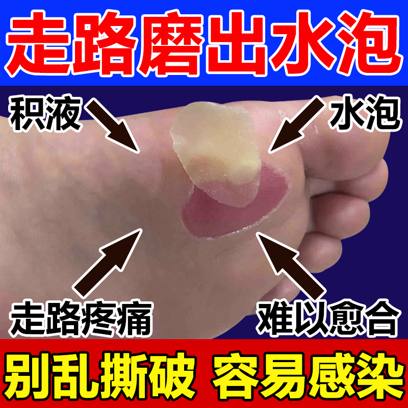 Friction on the Soles of the Feet Causes Blisters, Relieves Itching, Peeling Skin, and Infection of the Feet with Fluid Accumulation; Scar Removal Cream Promotes Healing