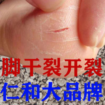 Fitting cream on the back of the heel to anti-dry cracking hands and feet peeling cracker cracking fungus infected the cracking cream