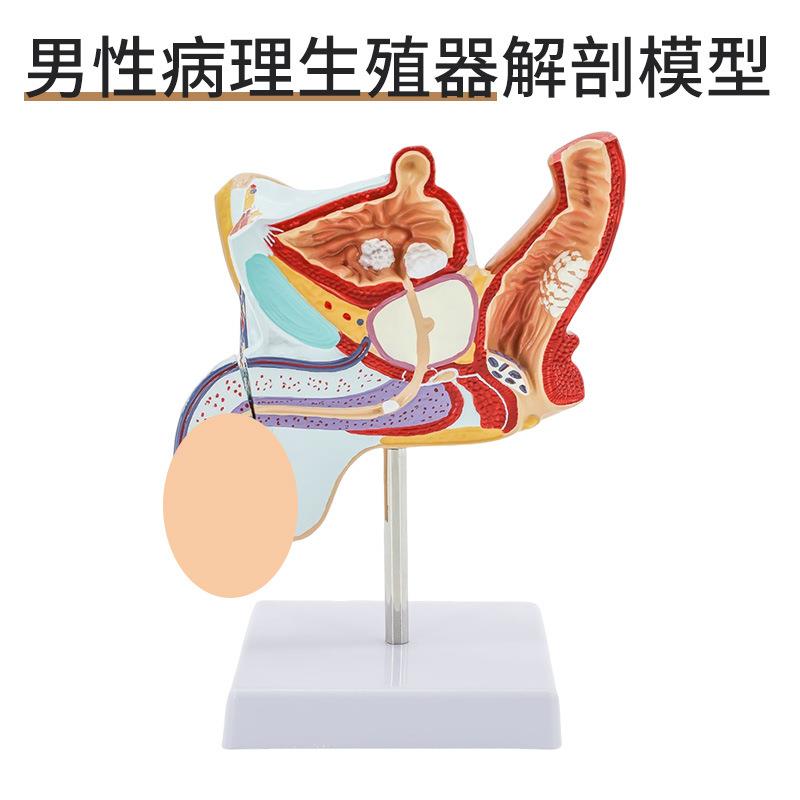 男性内生殖病理模型 病变男性生殖解剖模型 男泌尿系统疾病模型