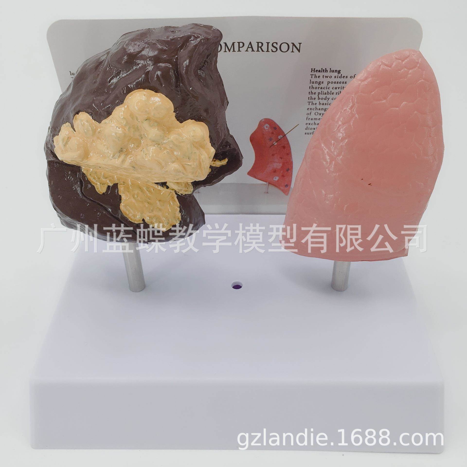 人体内脏健康肺与病态肺比较模型 正常肺解剖模型 病理肺对比模型