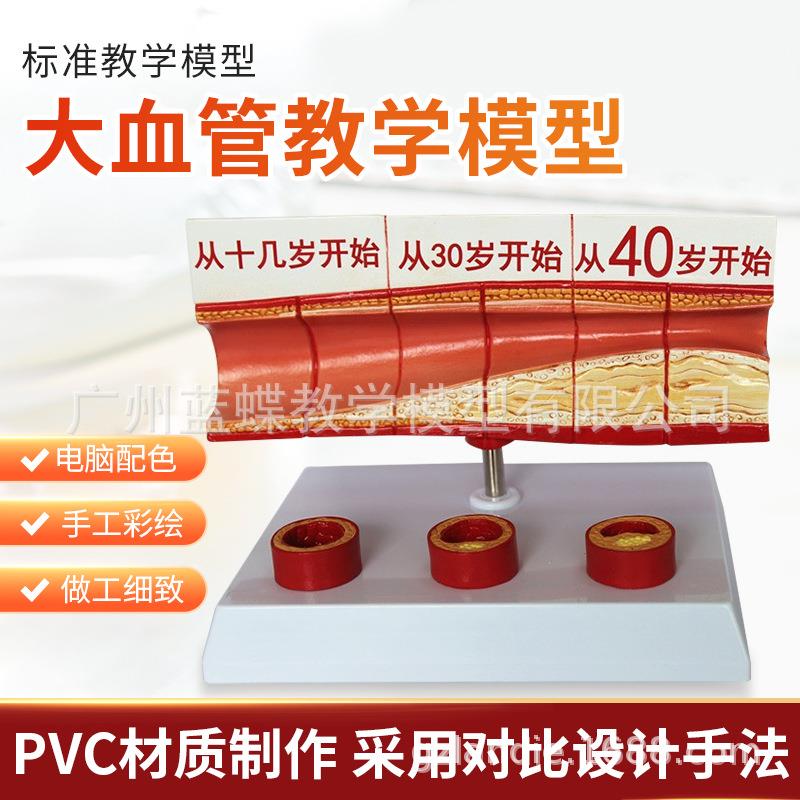 人体血管解剖模型 血管模型 动脉/硬化展示 各阶段年龄层血管展示