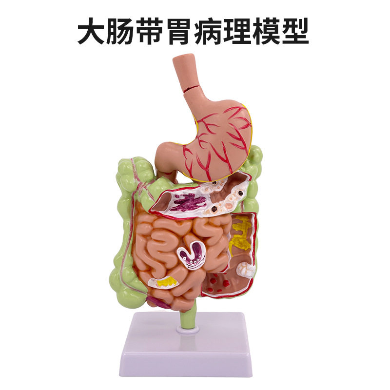 人体大肠病理模型 肠胃解剖模型 病态大肠盲肠 直肠 十二指肠模型