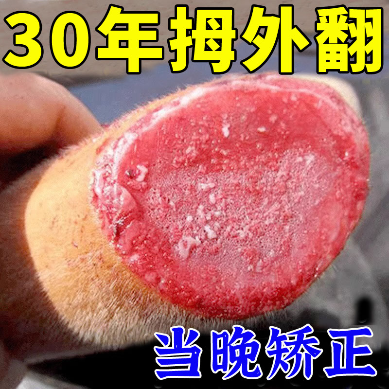 201% Correction) Hallux Valgus Correction Patch Treatment Big Toe Hallux Valgus Foot Finger Deformed Hallux Valgus Ointment Patch MH-Taobao