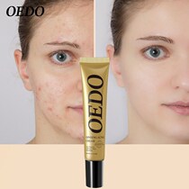 Acne atment Blackhead Removea Aanti Acne Cream Oil Control Shr