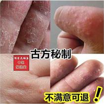 Hand cream for cracked hands athletes foot cream anti-itching peeling sterilizing blister-type artifact foot odor fungal infection rotten feet