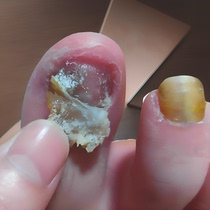 (Tongrentang hot sale) Painless replacement of potassium enjoy a good nail life turn bad nails into good ones drop by drop