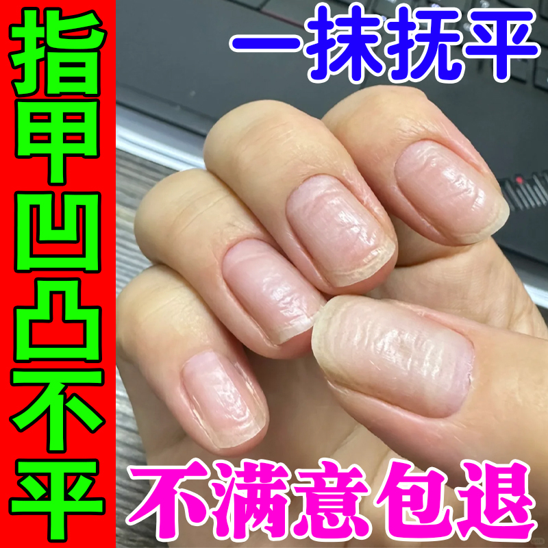 Specializing in Uneven Nails, Cracked Pits, Hollow Nails, Damaged Nail Bed, Separated Nail Surface, Vertical Pattern, Layered Repair Artifact