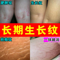 Stretch mark elimination pregnancy firming belly removal obesity postpartum prevention line growth prevention obesity mark removal artifact
