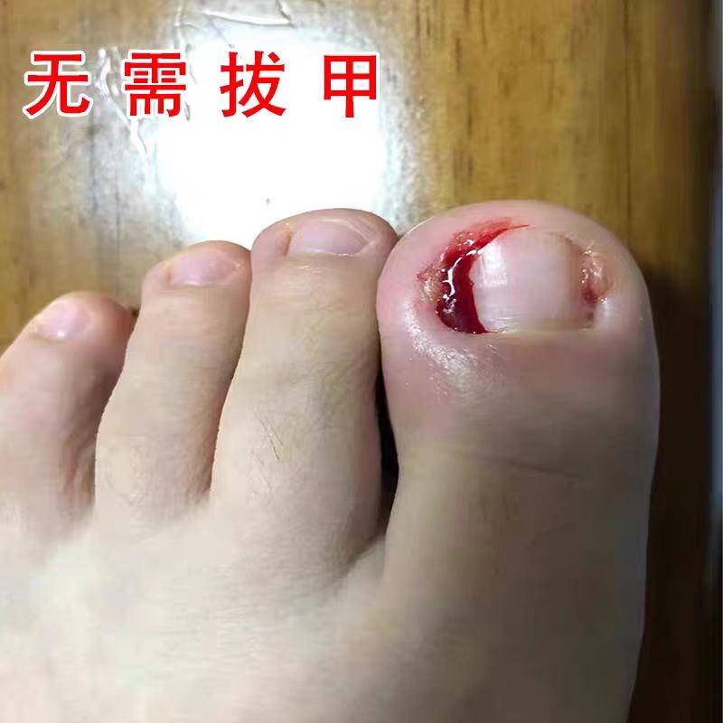 Specialized Ointment for Removing Polyps, Treating Toenail Abscesses, and Softening Nail Grooves