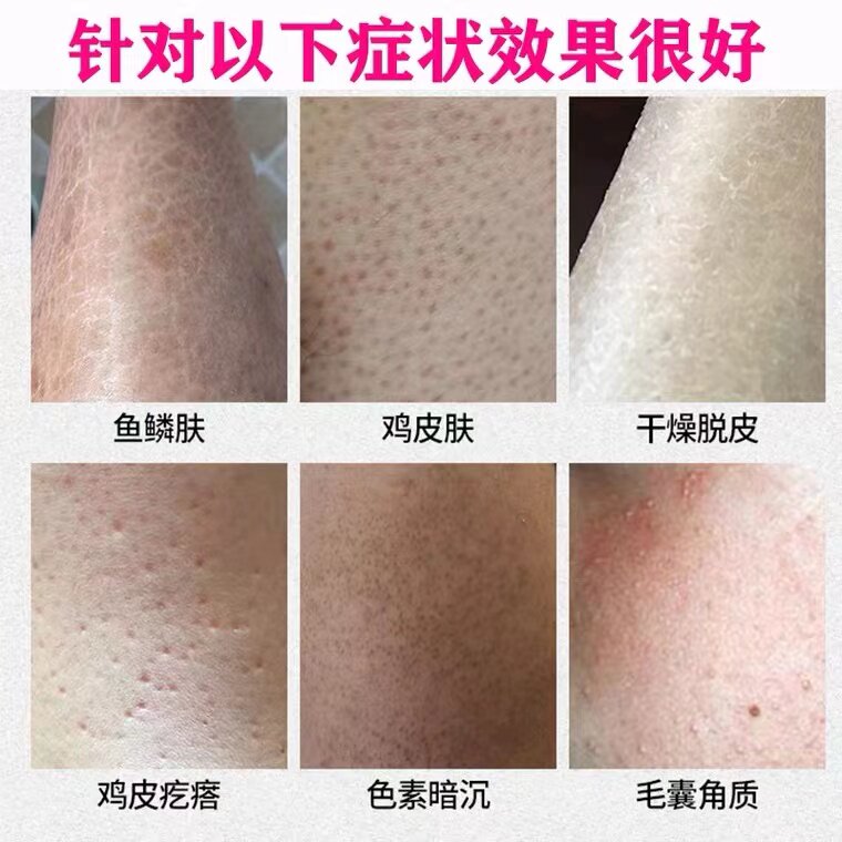 冬天腿上全是皮是怎么回事？如何轻松告别粗糙双腿？2026护肤新趋势全知道