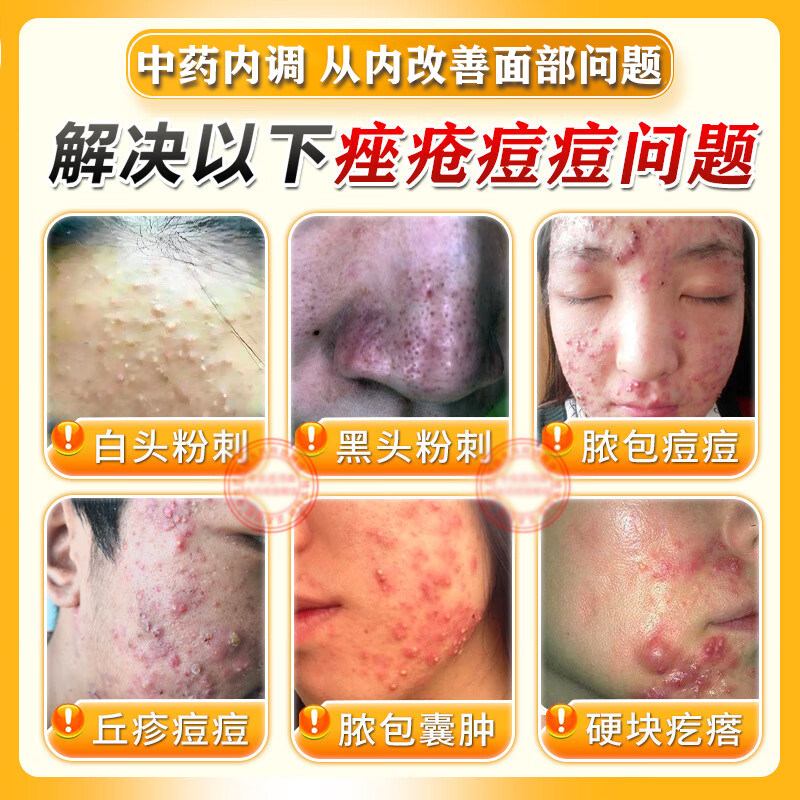 清热暗疮丸｜祛痘内调神器！爆痘期救星，从根源调理不反弹🔥-皮脂汗腺-淘宝好物网
