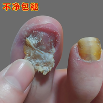 (Watson’s hot sale) One drop of it inhibits bacteria without removing nails removes 99% of gray potassium fungi and guarantees refund if ineffective.