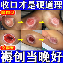 Decubitus wound healing promotes growth scalds scabs black holes bed-ridden sores (including broken bones) saprophytic and muscle-removing cream