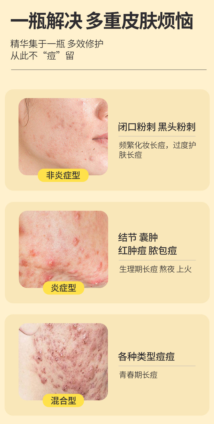 【中国直邮】 会美 七味姜黄搽剂  苗方中药 快速祛痘 闭口粉刺 痤疮脂溢性皮炎  10ml/盒