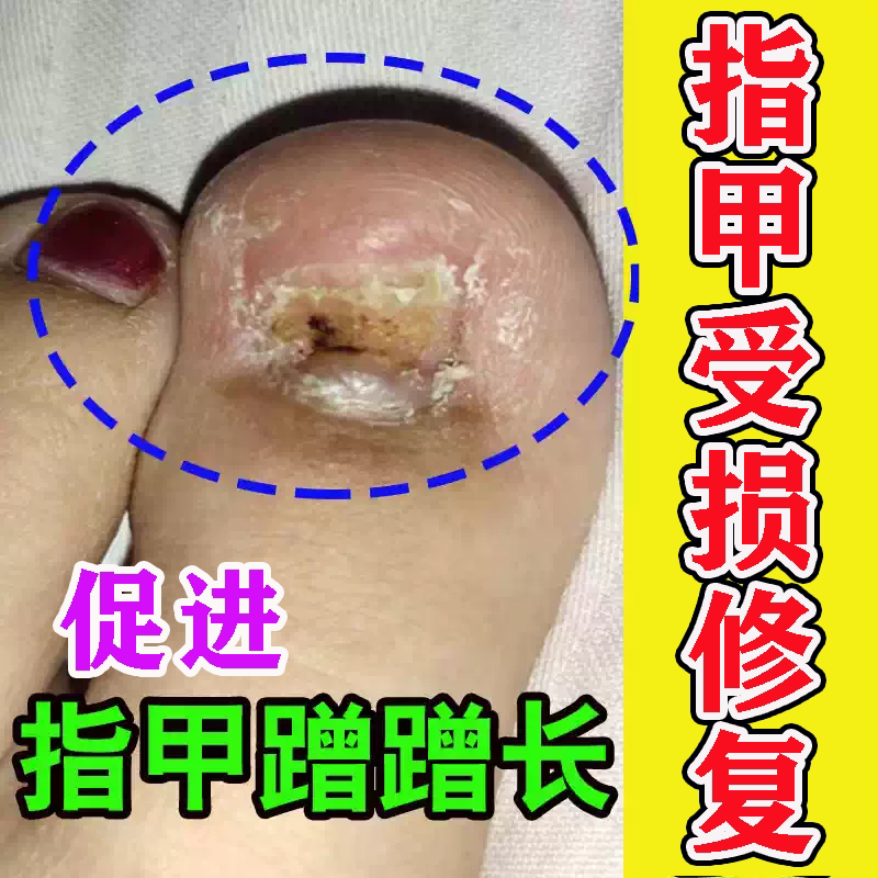 After Removing the Nail, the Nail Bed Is Damaged and the Repair Growth Solution Is Used to Treat the Nail Bed Atrophy, Injured Nails, Short Nails, Uneven Nails, and Hollow Nails