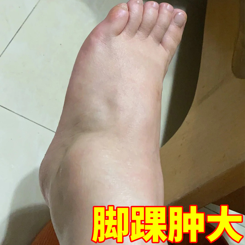 Ankle Injury, Sprained Ankle, Walking Aid, Sprained Ankle, Hot Compress, Ankle Pain, Ligament Strain Recovery, Special Adhesive Patch