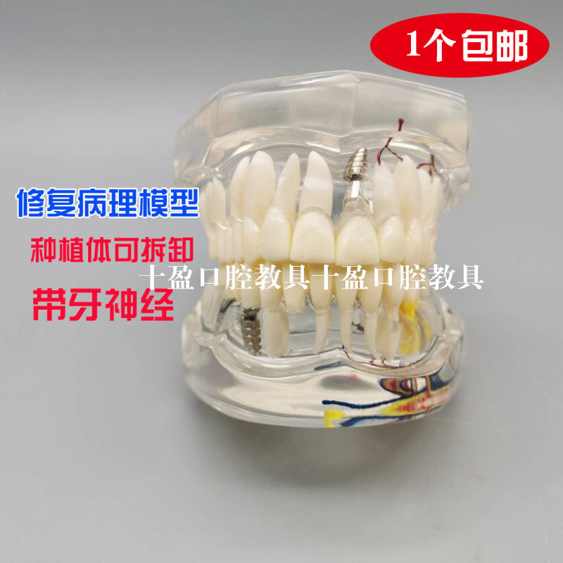 牙科口腔教学 可拆卸种植体修复模型 活动牙种植牙 医患沟通 包邮