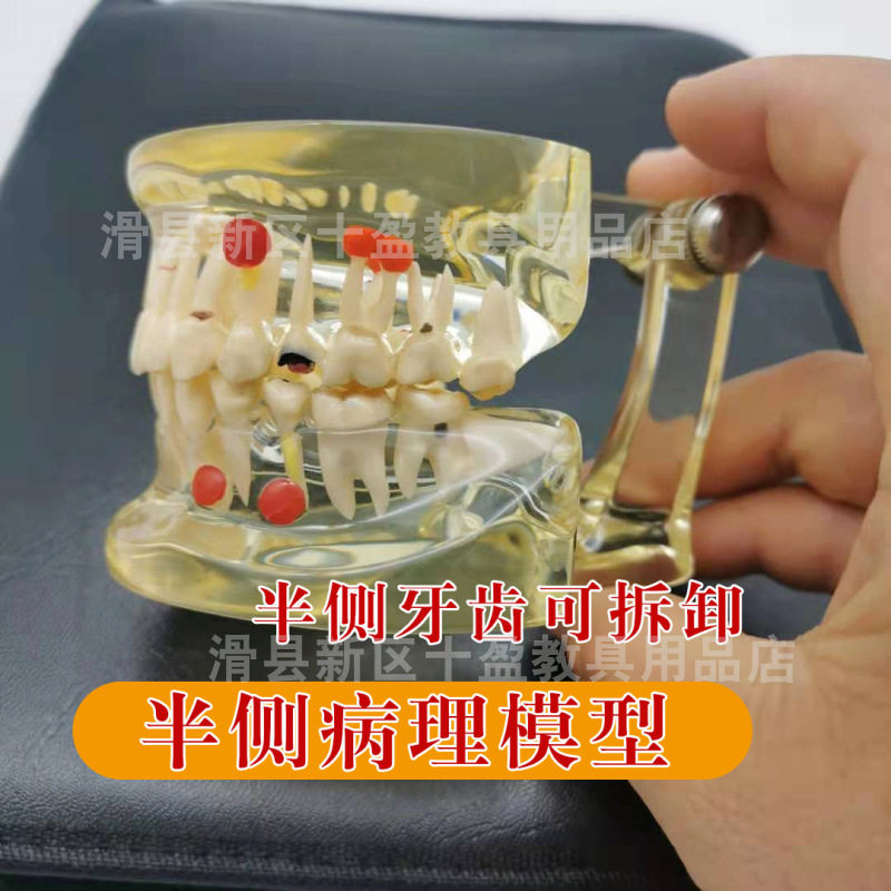 牙科口腔教学成人病理模型半侧可拆卸病理模型 龋齿龋坏医患沟通