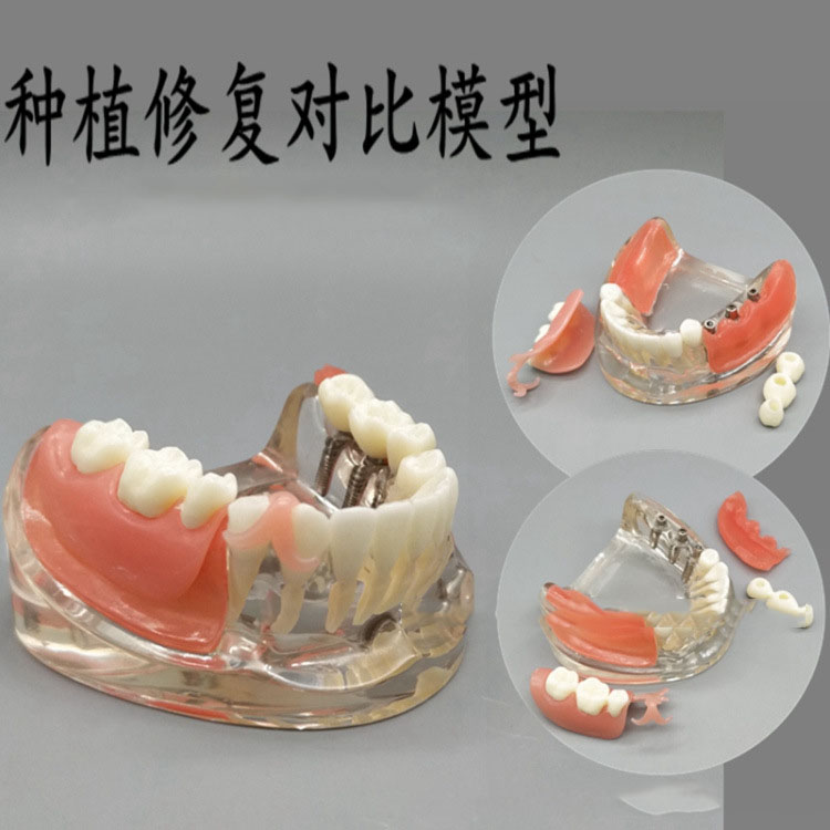 牙科 种植与修复对比模型局部活动义齿 种植连桥冠3颗种植钉解说
