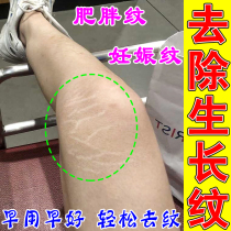 Students long white obesity lines on thighs expansion lines shrinkage fade lines removal of growth lines obesity pattern repair cream