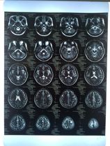 CT film) Radiation magnetic resonance film) X-ray A314*17CRDR film) X-ray PET film) Black and white laser