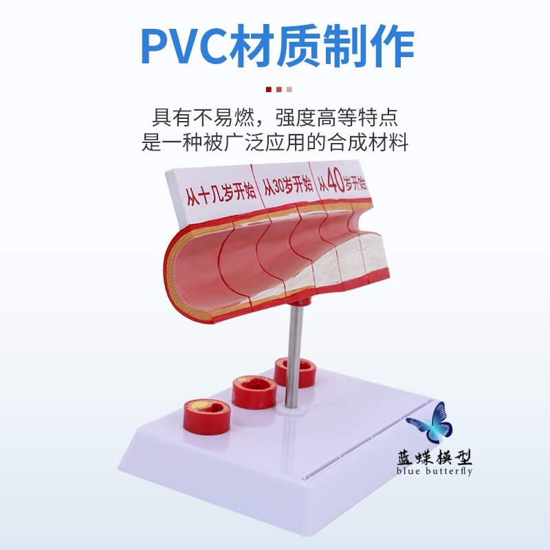 Human Cardiovascular Hierarchical Structure Anatomy Blockage Model Thrombosis Fat Pathology Arteriovenous Enlargement and Hardening Teaching Aids