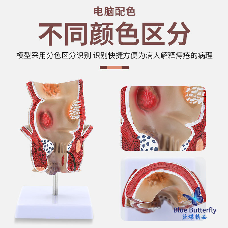 Straight Intestines Hemorrhoids Disease Turns into Model Hemorrhoids Internal and External Anatomy Anal and Intestinal Surgery Large Intestine Intestinal Pathology Model
