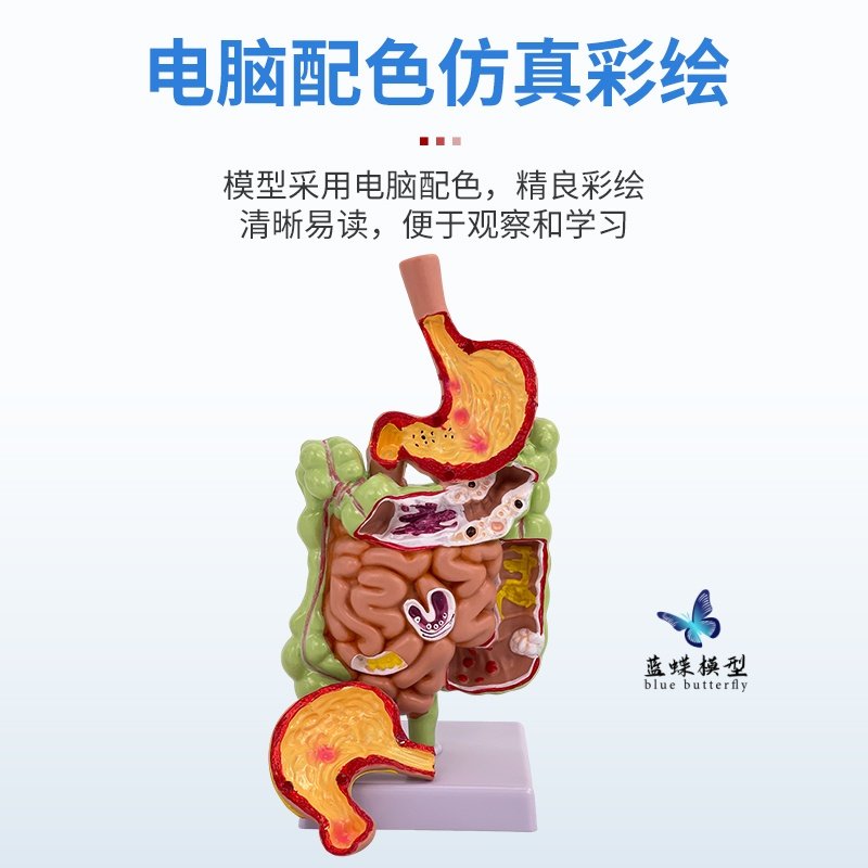Human Stomach Anatomy Model, Stomach Lesion Model, Stomach Disease Demonstration Model, Pathological Stomach, Gastric Perforation