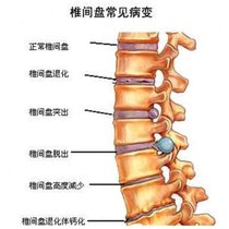 Jingzhutang lumbar disc patch special patch for lumbar spine lumbar muscle strain low back pain and pain plaster patch