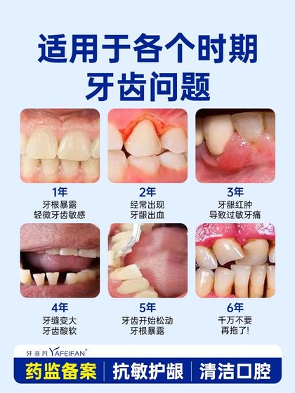 牙非凡医用口腔护理脱敏膏疗牙治齿过敏牙龈萎缩牙周炎出血牙膏xu