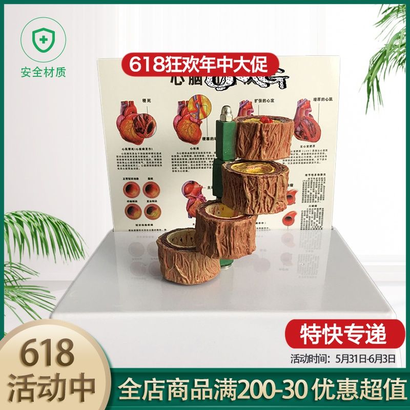 动脉  粥样硬化模型 血栓病变模型 血管病演示心脏模型 血管病理