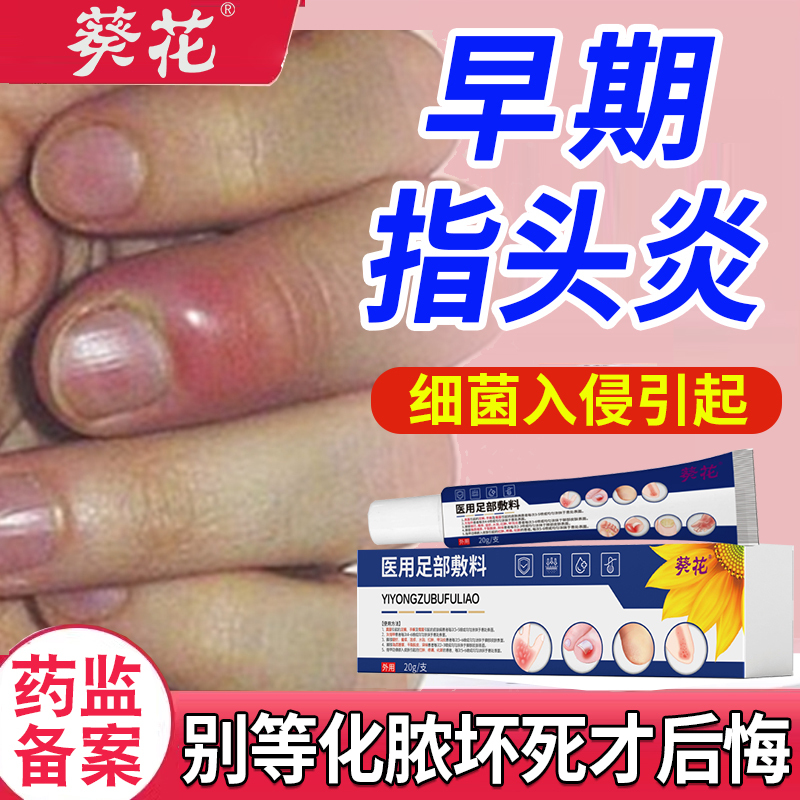 Purulent Finger Inflammation, Finger Nail Fungus Infection, Ointment for Paronychia, Swelling and Pain Around the Edges of the Nail Groove