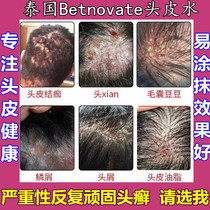 Thailand Betnovate Scalp Water Severe scalp ringworm Large dandruff red lump Pimple Hair follicle red inflammation