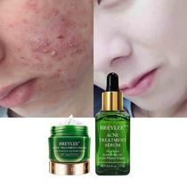 Tea Tree Acne Solution Kit Acne Treatment cream茶树祛痘套装