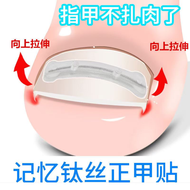 Ingrown Toenail Correction Wire Silicone Patch Nickel Alloy Memory Metal Nail Groove Corrector Toenail Splinter Correction Patch