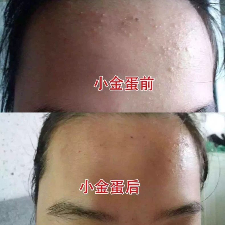 Bí quyết y học Trung Quốc Newwey với kem trị mụn trứng vàng nhỏ giúp làm sáng da mụn trứng cá kem trị mụn trứng cá nam nữ kem dưỡng ý dĩ