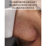 Жидкость для экспорта черных точек, закрытая вода от прыщей, удаление черных точек, сужение пор, специальная корейская линия для салонов красоты с маленькими пузырьками