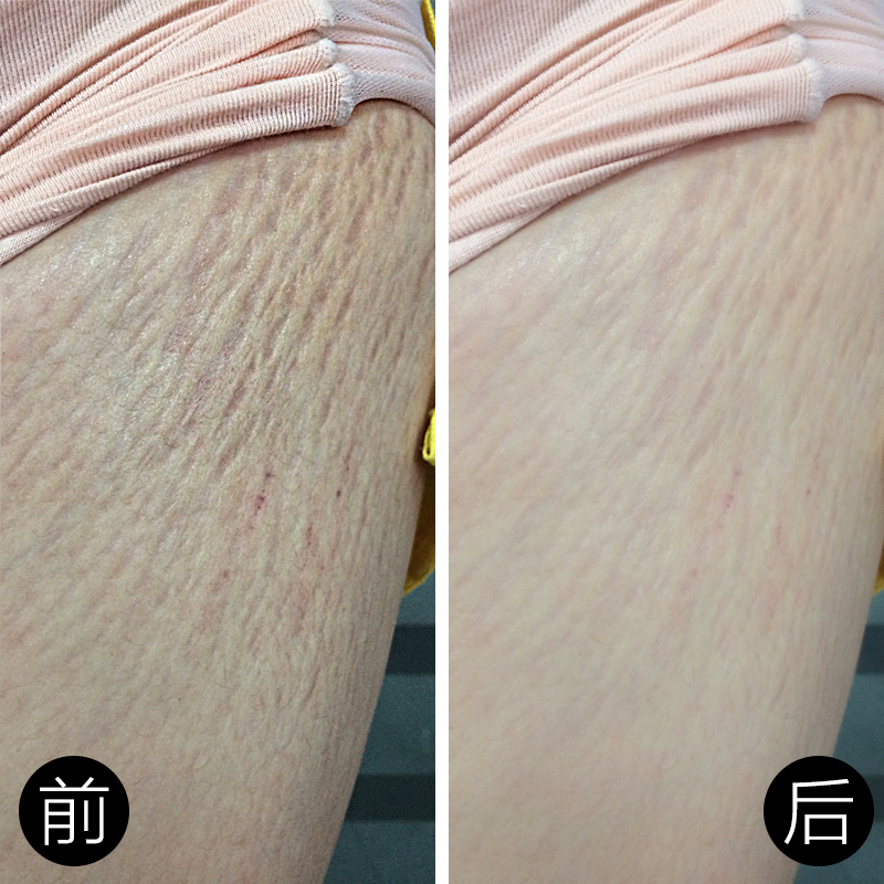 妊娠期孕纹预防修复霜 孕妇专用产后产前去妊辰肥胖纹消除紧致