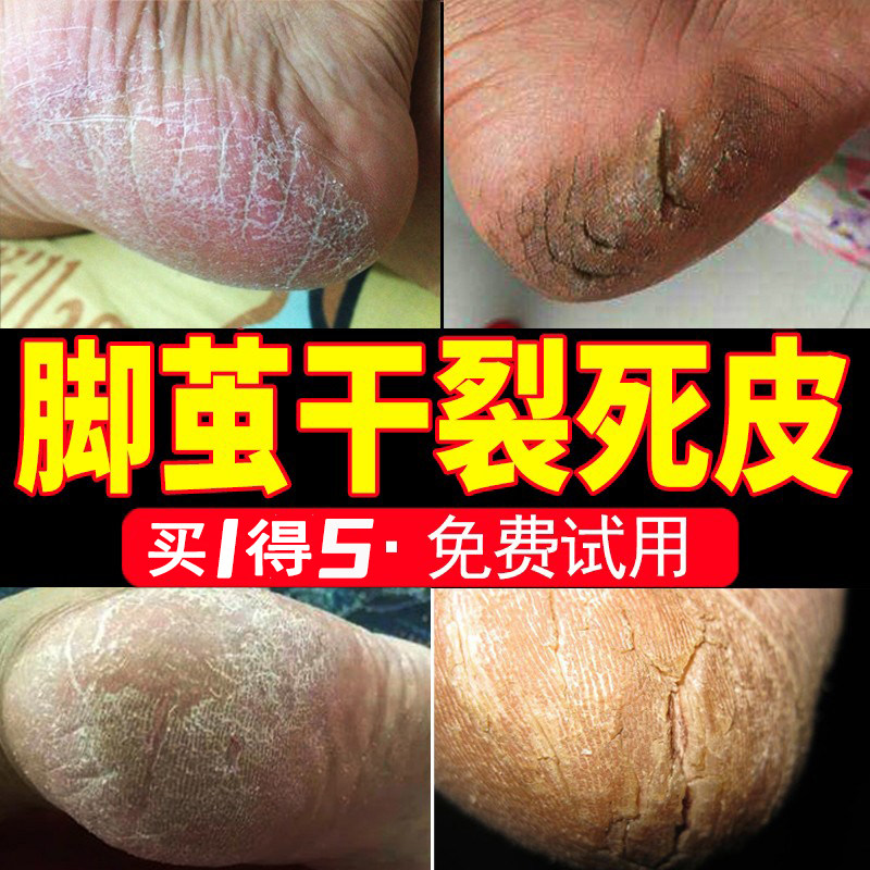 The soles of the feet are dry and cracked, the calluses, the foot film, the old skin, the hard skin, the foot film, the foot skin, the heel artifact, and the dead skin softener.
