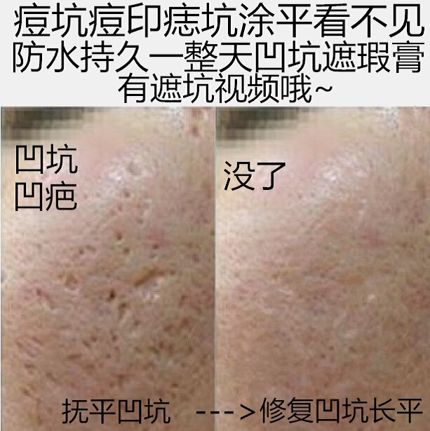 Concealer Pen for Covering Acne Pits, Acne Marks, and Scars, Concealing Pores, Long-Lasting Magic Tool for Men and Women's Face