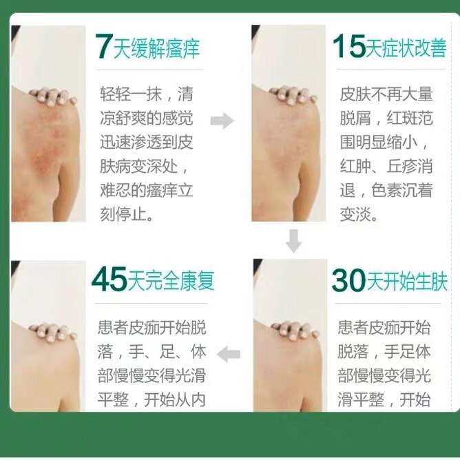 埃及牛皮止痒癣廯特效乳膏真的能搞定皮肤瘙痒湿疹吗?2026年必备护肤黑科技详解-私处护理器械-淘宝百科网