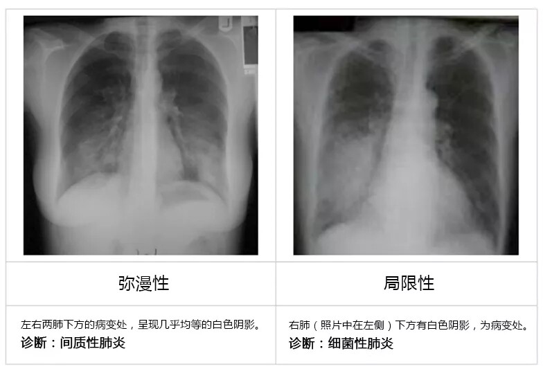 肺炎诊断治疗血清学标志物：KL-6、SP-A、SP-D