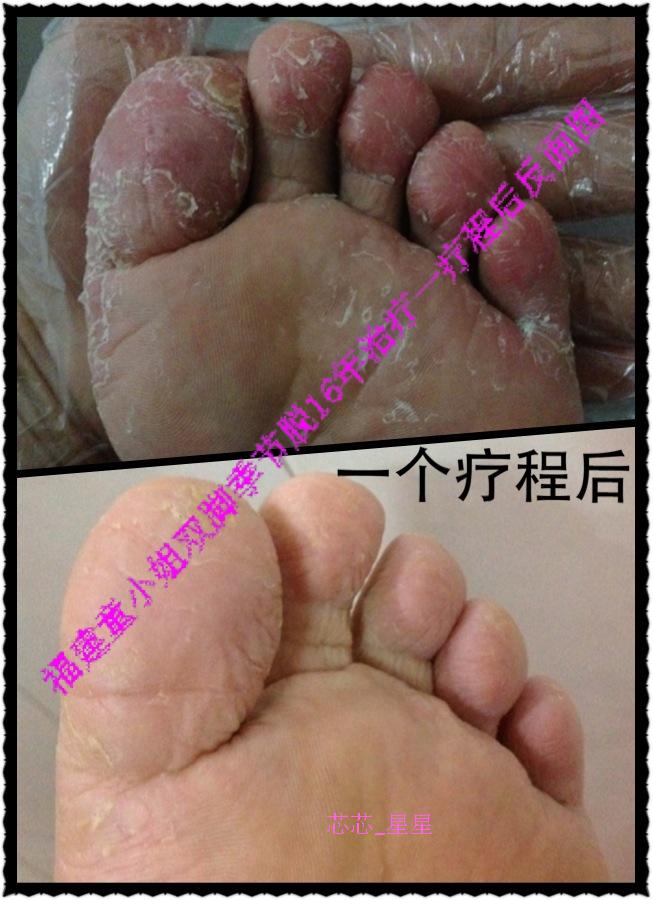 脫皮錯當香港腳 難怪治不好 落屑性角層分離 高雄林政賢皮膚科診所