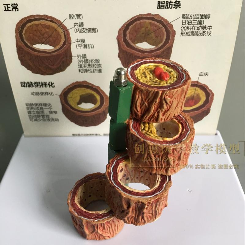 血管解剖模型 动脉粥样化 病理心血管 血液循环医学促销模型