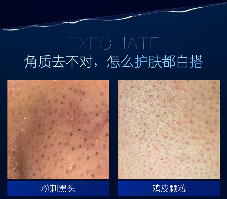 Nửa thứ hai giá tẩy tế bào chết cho nam nữ mặt đến da chết mụn đầu đen tẩy tế bào chết toàn mặt tẩy da chết cho nam